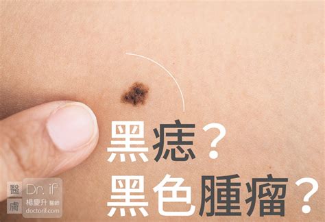 黑痣凸起|不大驚小怪！如何辨別「黑痣」與「黑色腫瘤」？ 